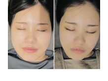 あくび 西麻布(aqu美)/フェイシャル,小顔調整,美容鍼