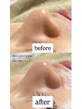 クレヴィー(Creviy)/3D毛穴洗浄×ハーブ×産毛脱毛