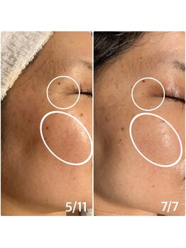 楚々(SOSO)/before after