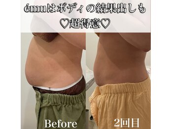 エミュ(emu)/ウルトラ痩身でぽっこり解消