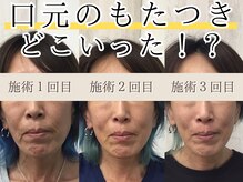 小顔専門だから叶う、エラ張り・たるみ・脂肪などの症状別ケア♪