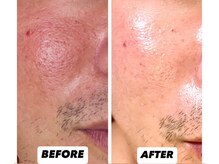 ジャスミン(JASMINE)/ハーブピーリングフルオプション