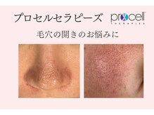 ミレット(Miretto)/毛穴の開きに♪プロセル