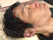 とだ鍼灸院/側頭部の頭痛！顎関節の痛み