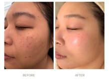 ラシェプリズ(LACHER PRISE)/シミケア・改善例