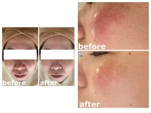 水素インナーケア×最新肌管理/ビフォーアフター