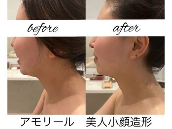 アモリール(Amolir)/本格小顔造形ビフォーアフター