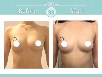 美人バスト 赤羽店/【バストアップ★育乳】症例