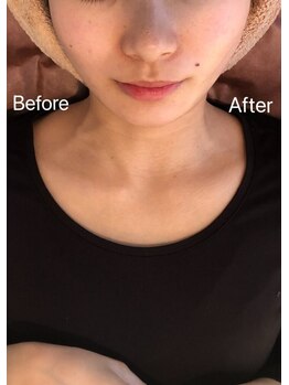 リフト 門前仲町(Lift)/小顔専門店Lift|Before After