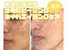 【本気の美肌改善・年齢肌】透明肌ピーリング☆アドバンスコース