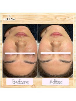 ウィズリリナ 新横浜(with Lilina.)/1回/ハーブピーリング/新横浜