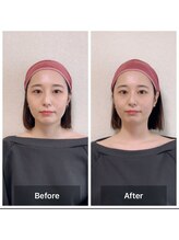 ラニ(Lani)/小顔美人整顔ビフォーアフター