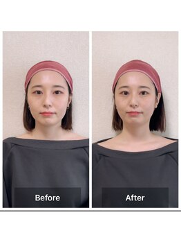 ラニ(Lani)/小顔美人整顔ビフォーアフター