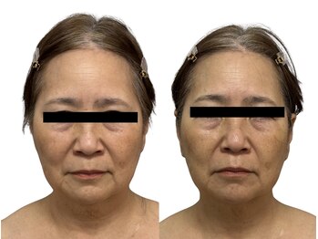 リノン(LIINON)/継続が美を作る!