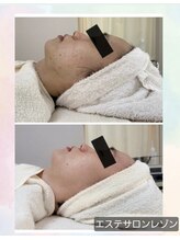 レゾン 京橋店/【Before/after】ニキビケア