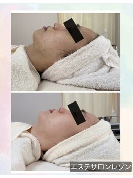 レゾン 京橋店/【Before/after】ニキビケア