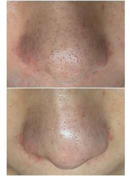 リアン(LIAN)の写真/【毛穴の汚れが出てくる！出てくる！】毛穴プロしか使えない特殊なローションを使い、毛穴悩みを徹底改善！