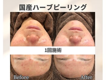 イーラボ 池袋店(e-LABO)/大人気!国産ハーブピーリング