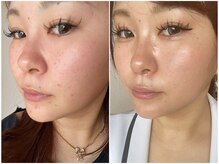 シャイネル(SHYNELL)の雰囲気(大人気ハーブリプロで叶える肌質改善☆誰もがなりたい素肌へ)