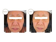 リア(Li'a.)/光フェイシャル