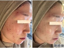 エヴァル 久留米店(ewalu)/ララピールの進化版☆セラピール