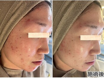 エヴァル 久留米店(ewalu)/ララピールの進化版☆セラピール