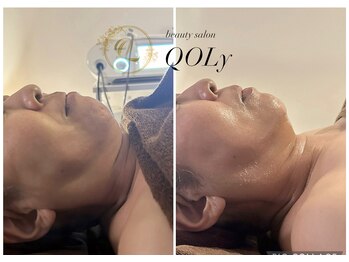 コリー(QOLy)/インディバでリフトアップ