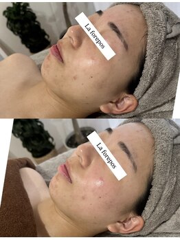 ラ フォルポ 恵比寿(La forepos)/ハーブピーリング恵比寿代官山