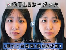 【韓国美白LED】たった一度でもこの変化！(個人差はあります)