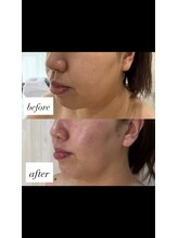 ダウンタイムオンニ(DowntimeOnni)/切らない小顔リフト