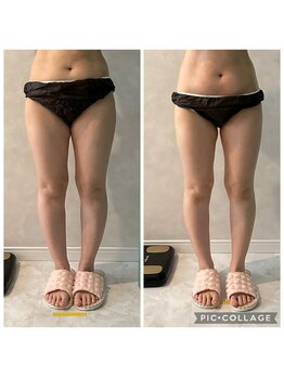 エクラ(Eclat)/Eclatの痩身★BeforeAfter4