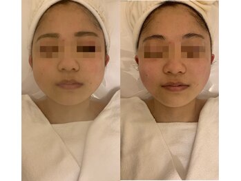 ナラビューティー(NARA BEAUTY)/コルギ輪郭リフト 恵比寿小顔