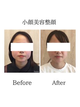 サロンベイビー 西宮本店(Salon Baby)/小顔人気No.1 小顔美容整顔30分
