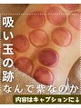 鍼灸院ワタナベコウヘイ(Watanabe Kohei)&nbsp;当院の吸い玉はカップを約100個使います！