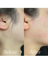 コラソン(CORAZON)/もみあげを綺麗に★