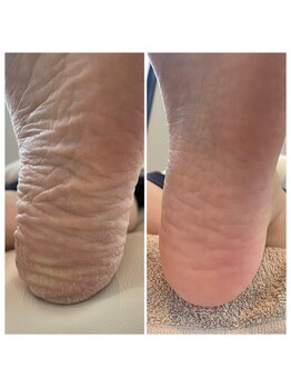 サロンドエー 帝塚山(Salon de A)/靴下のしたの足裏カサカサでは?