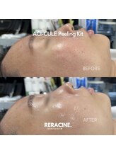 オーロラ 福岡行橋(AURORA)/水光３Dピーリング