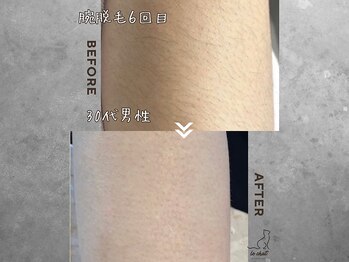 ル シャ/メンズ脱毛/毛穴洗浄/ヘッドスパ