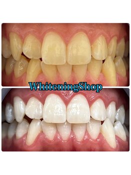 ホワイトニングショップ 山形店(Whiteningshop)/何歳でも綺麗でいたい