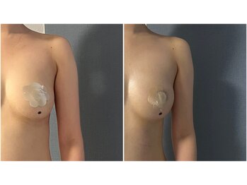 モア(moa)/バストケア3回ビフォーアフター