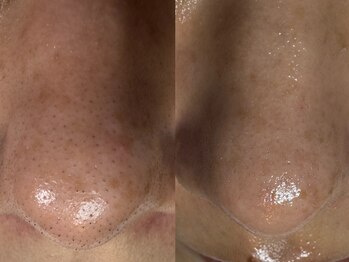 サラグランデ(Sara Grande)/毛穴エクストラクション