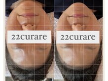 22クラレ(22curare)/小顔整顔で本来のお顔の形へ