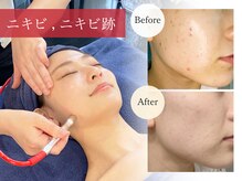 オーシャンブルー 福岡店(OCEAN BLUE フェイシャル&ボディ)の雰囲気（【韓国肌管理】ニキビケア人気No1！毛穴洗浄+美肌ピーリング）