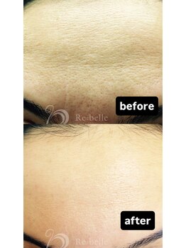 セレネ(SELENE)/毛穴の開き