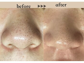 ソーヴ(SOLVE)/フェイスワックス/シェービング