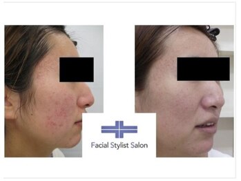 フェイシャルスタイリストサロン 四谷店/ケア例(41)