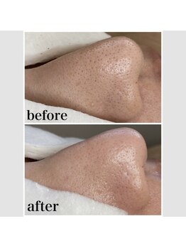 毛穴専科/ハイドラフェイシャル!