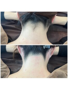 ピークハント(Peak Hunt)/うなじワックス脱毛