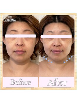 ウィズリリナ 新横浜(with Lilina.)/小顔頭蓋骨矯正/1回/新横浜