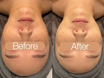 クレヴィア バイ サイバーエステ(CREBIA)/【高濃度ビタミンC】ILLUSTRIOUS